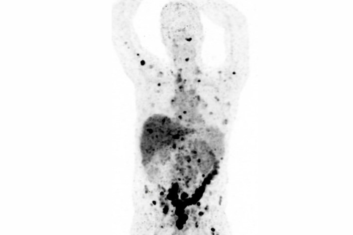 PET scan of metastatic cancer