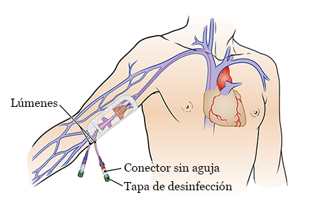 Figura 1. Partes de un PICC