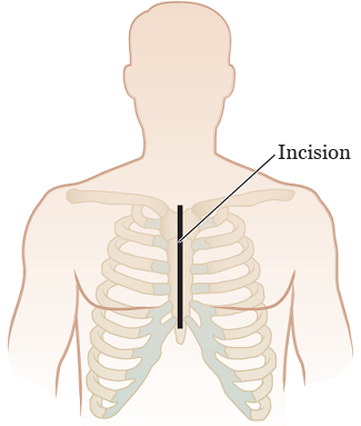 Figure 12. Median sternotomy incision