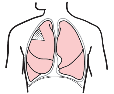 Figure 2. A wedge