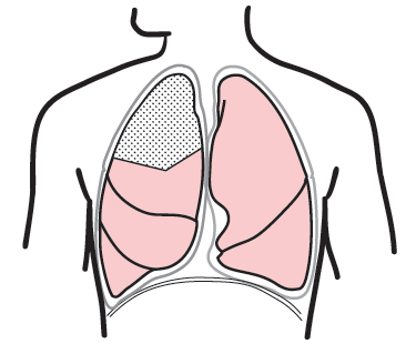 Figure 3. A&nbsp;segmentectomy