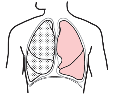 Figure 5. A&nbsp;pneumonectomy