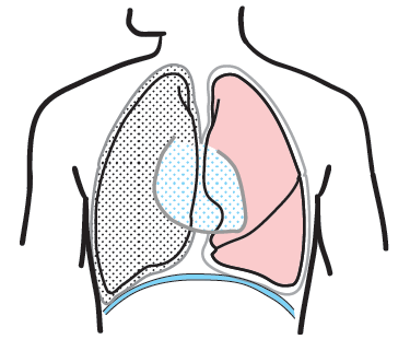 Figure 6.&nbsp;An extrapleural pneumonectomy