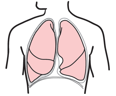 Figure 7. A&nbsp;pleurectomy and decortication