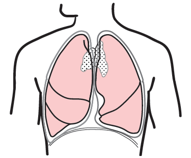 Figure 8. A&nbsp;thymectomy