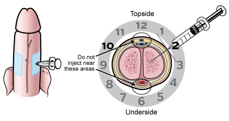 Figure 3. Choosing an injection site