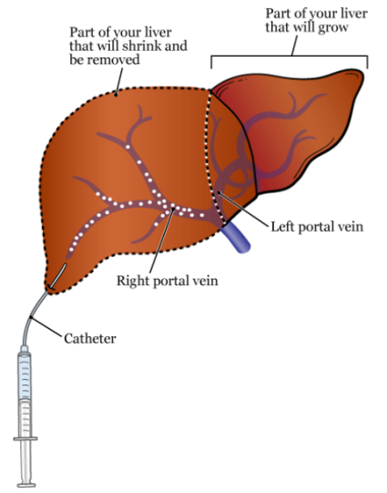 Figure 2. Portal vein embolization in the right portal vein of the liver